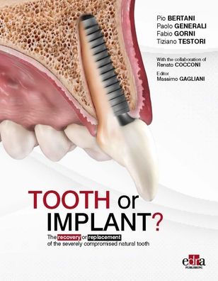 Tooth or Implant