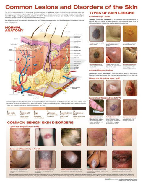 Common Lesions and Disorders of the Skin Anatomical Chart by Anatomical ...