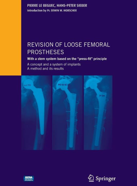 Revision of loose femoral prostheses with a stem system based on the "press-fit" principle: A concept and its system of implants, a method and its results / Edition 1