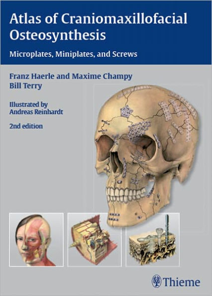 Atlas of Craniomaxillofacial Osteosynthesis: Microplates, Miniplates, and Screws