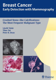 Title: Breast Cancer: Early Detection with Mammography: Crushed Stone-like Calcifications: The Most Frequent Malignant Type, Author: Laszlo Tabar