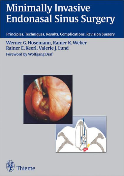 Minimally Invasive Endonasal Sinus Surgery: Principles, Techniques, Results, Complications, Revision Surgery