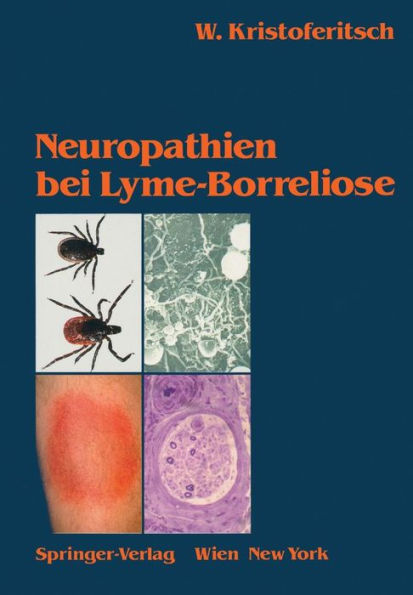 Neuropathien bei Lyme-Borreliose