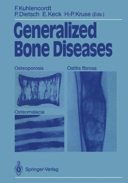 Generalized Bone Diseases: Osteoporosis Osteomalacia Ostitis fibrosa / Edition 1