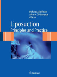 Title: Liposuction: Principles and Practice / Edition 1, Author: Melvin A. Shiffman