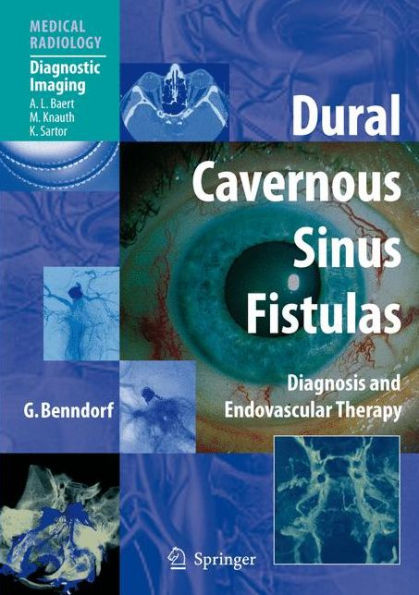Dural Cavernous Sinus Fistulas: Diagnosis and Endovascular Therapy / Edition 1