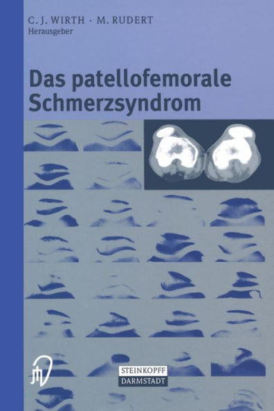 Das patellofemorale Schmerzsyndrom