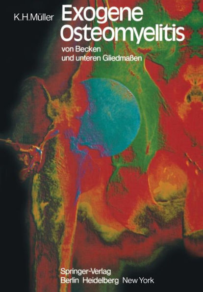 Exogene Osteomyelitis von Becken und unteren Gliedmaßen: Besonderheiten Pathogenese Klinik Therapie Ergebnisse