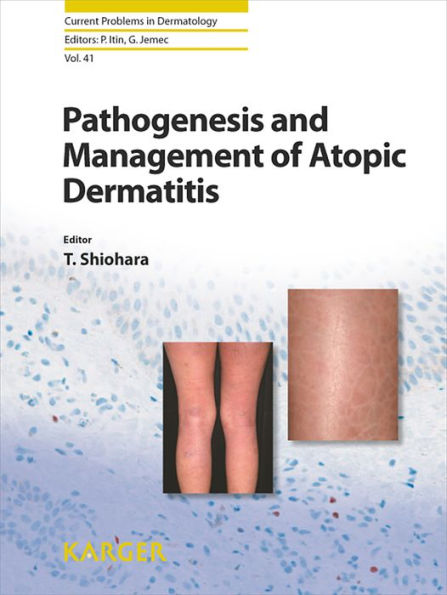 その他 Pathogenesis and Management of Atopic Pathogenesis and Management of Atopic Dermatitis by T