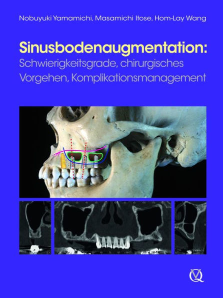 Sinusbodenaugmentation: Schwierigkeitsgrade, chirurgisches Vorgehen, Komplikationsmanagement