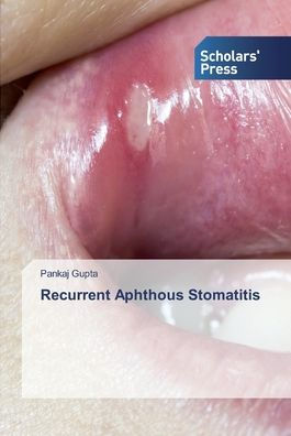 Recurrent Aphthous Stomatitis