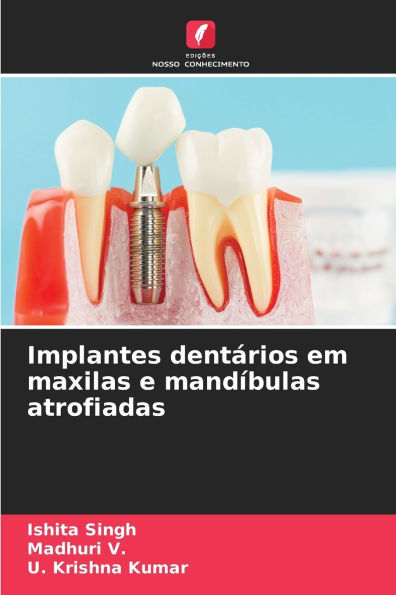 Implantes dentÃ¯Â¿Â½rios em maxilas e mandÃ¯Â¿Â½bulas atrofiadas