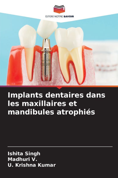 Implants dentaires dans les maxillaires et mandibules atrophiÃ¯Â¿Â½s