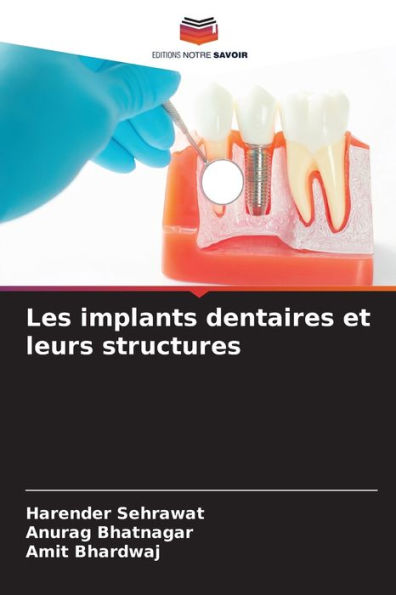 Les implants dentaires et leurs structures