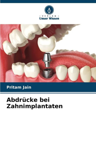 Abdrücke bei Zahnimplantaten