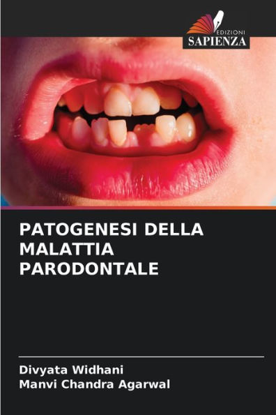 PATOGENESI DELLA MALATTIA PARODONTALE