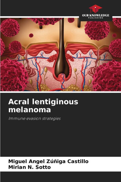 Acral lentiginous melanoma