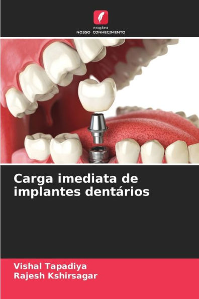 Carga imediata de implantes dentï¿½rios