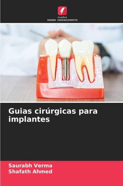 Guias cirï¿½rgicas para implantes
