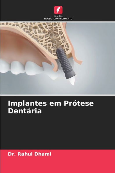 Implantes em Prï¿½tese Dentï¿½ria