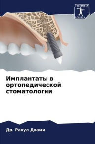 Title: Имплантаты в ортопедической стоматологи, Author: Др. Рахул Дхами
