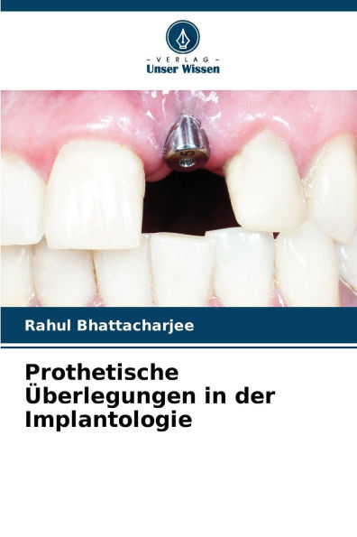 Prothetische �berlegungen in der Implantologie