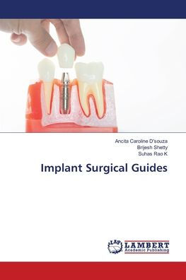 Implant Surgical Guides