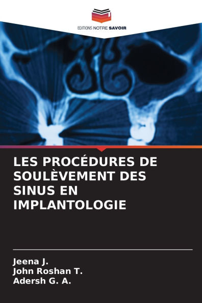 Les Procï¿½dures de Soulï¿½vement Des Sinus En Implantologie