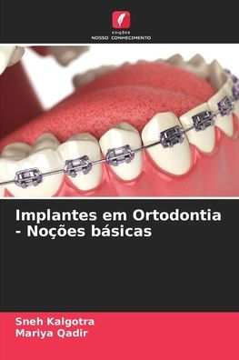 Implantes em Ortodontia - Noï¿½ï¿½es bï¿½sicas