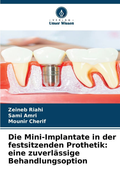 Die Mini-Implantate in der festsitzenden Prothetik: eine zuverlï¿½ssige Behandlungsoption