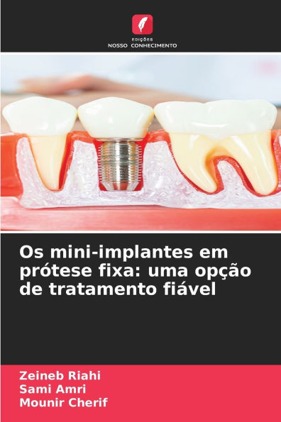 Os mini-implantes em prï¿½tese fixa: uma opï¿½ï¿½o de tratamento fiï¿½vel