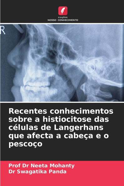 Recentes conhecimentos sobre a histiocitose das cï¿½lulas de Langerhans que afecta a cabeï¿½a e o pescoï¿½o