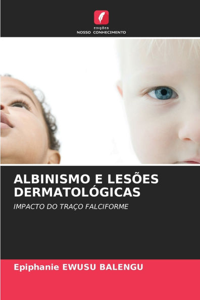 Albinismo E LesÃ¯Â¿Â½es DermatolÃ¯Â¿Â½gicas
