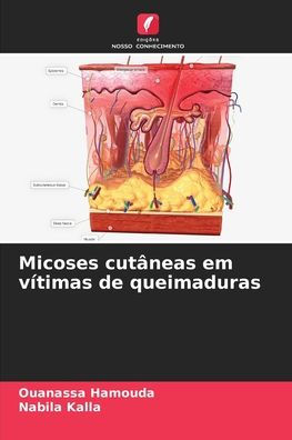 Micoses cut�neas em v�timas de queimaduras