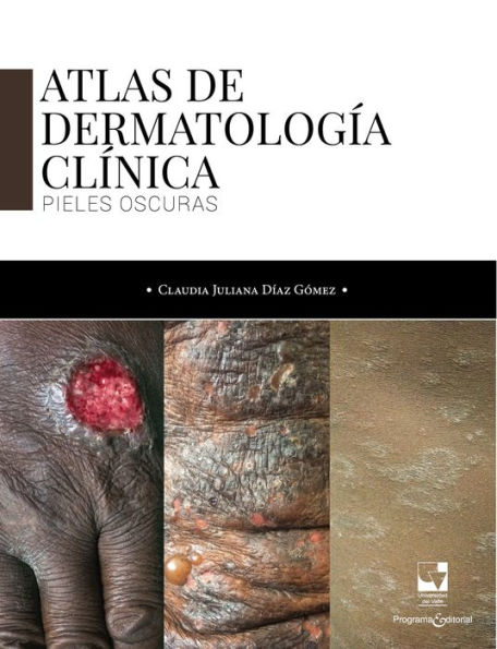 Atlas de dermatología clínica: Pieles oscuras
