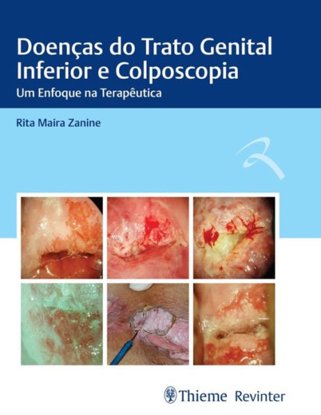 Doenças do Trato Genital Inferior e Colposcopia: Um Enfoque na Terapêutica