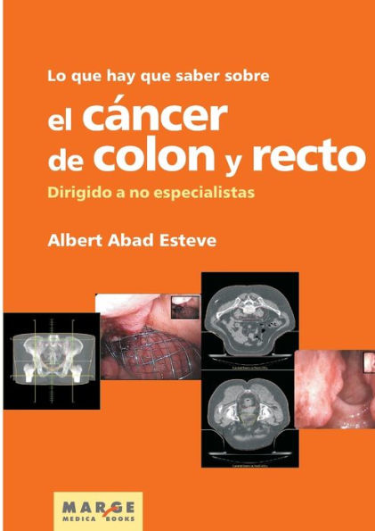 Lo que hay que saber sobre el cï¿½ncer de colon y recto