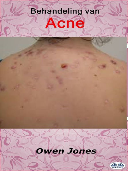 Behandeling Van Acne