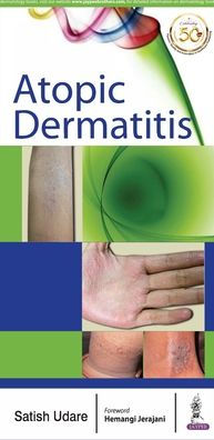 Atopic Dermatitis