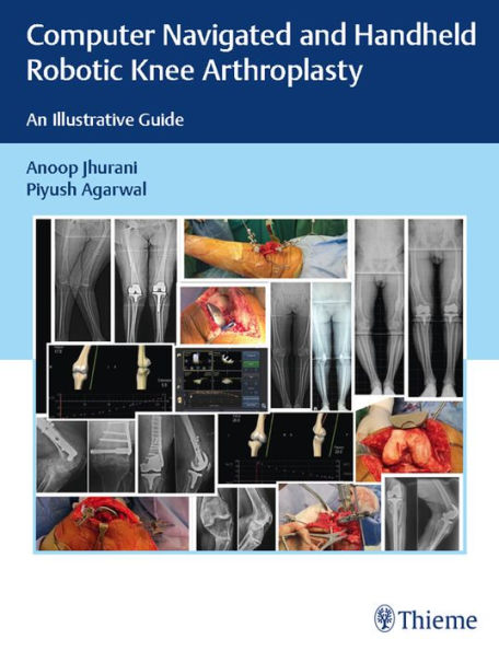 Computer Navigated and Handheld Robotic Knee Arthroplasty: An Illustrative Guide