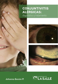 Title: Conjuntivitis alérgicas: Diagnóstico y tratamiento, Author: Sandra Johanna Garzón Parra