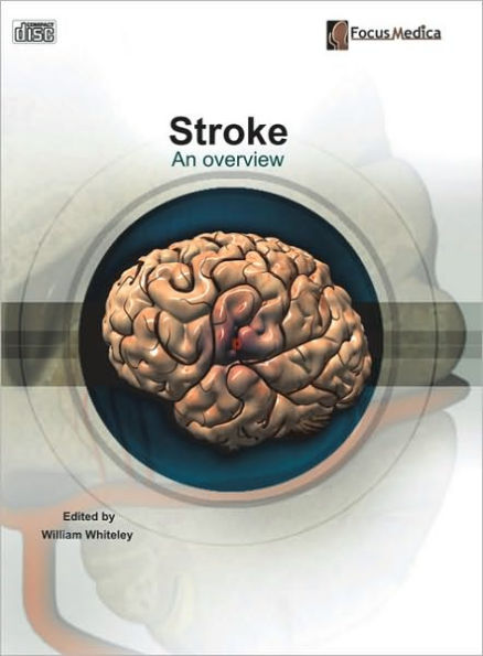 Stroke: An Overview