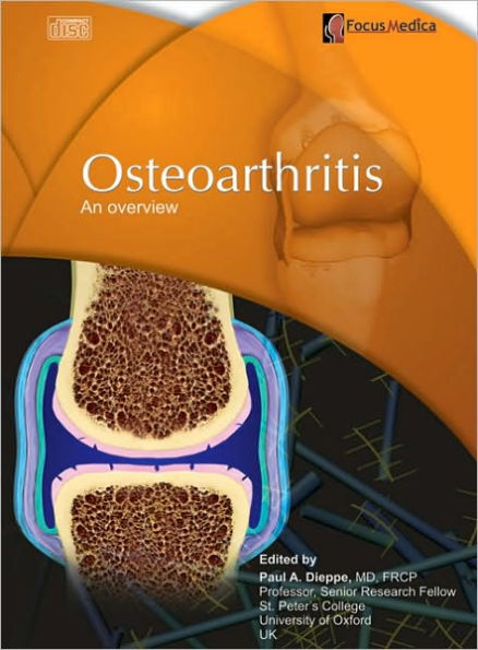 Osteoarthritis: An Overview
