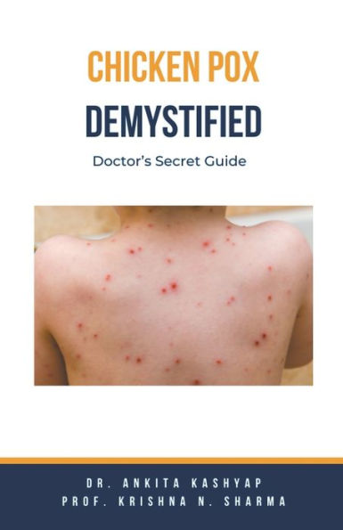 Chickenpox Demystified: Doctor's Secret Guide