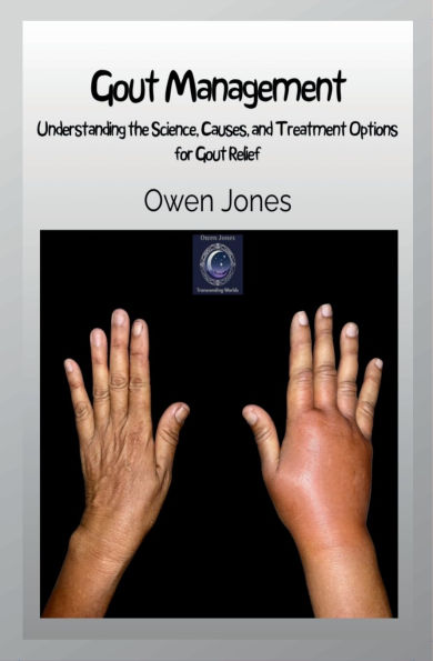 Gout Management: Understanding the Science, Causes, and Treatment Options for Gout Relief