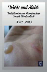 Title: Warts and Moles: Understanding and Managing these Common Skin Conditions, Author: Owen Jones