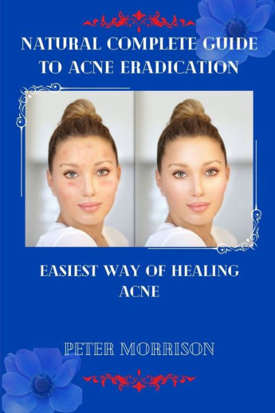 NATURAL COMPLETE GUIDE TO ACNE ERADICATION: EASIEST WAY OF HEALING ACNE