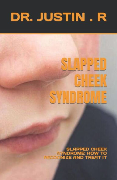 SLAPPED CHEEK SYNDROME: SLAPPED CHEEK SYNDROME: HOW TO RECOGNIZE AND TREAT IT