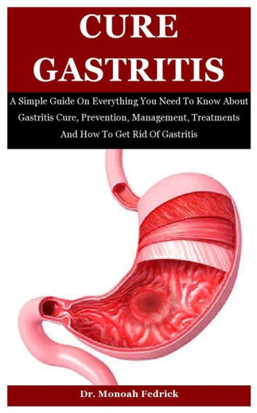 Cure Gastritis: A Simple Guide On Everything You Need To Know About Gastritis Cure, Prevention, Management, Treatments And How To Get Rid Of Gastritis