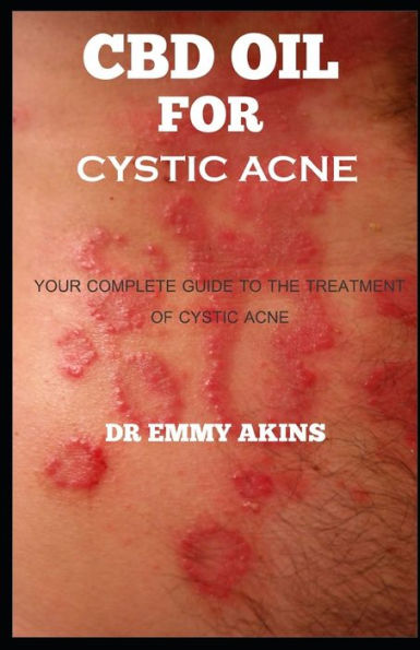 CBD OIL FOR CYSTIC ACNE: Your Complete guide to the Treatment of Cystic Acne